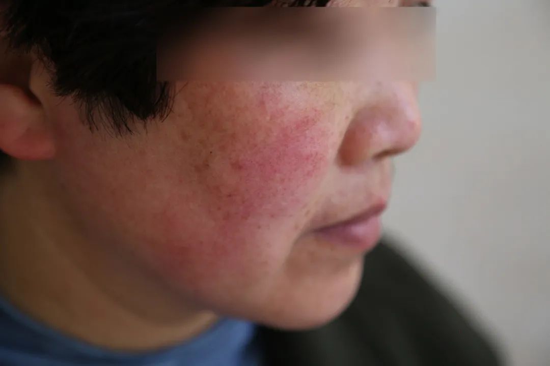 她的情况属于颜面再发性皮炎,是一种面部依赖性皮炎