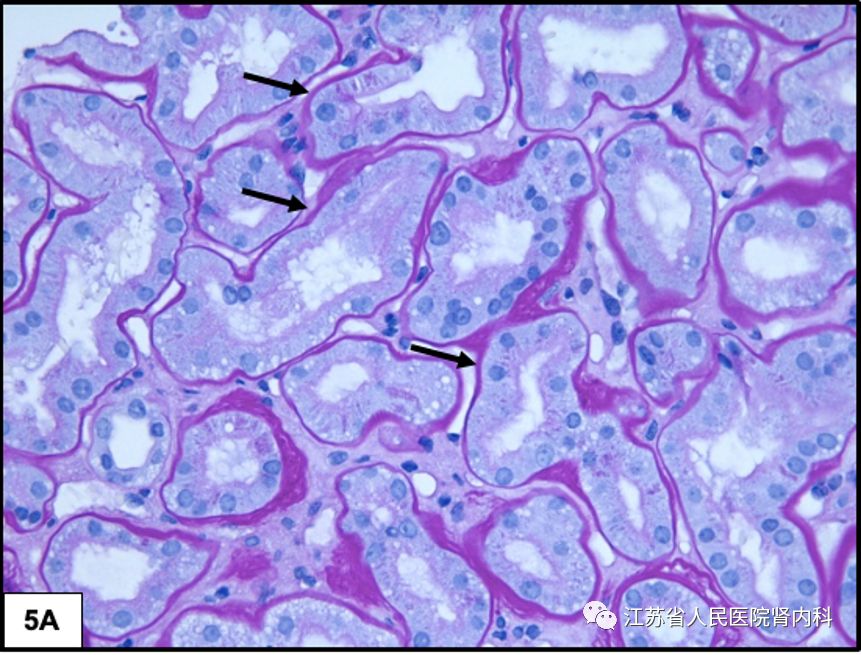 肾脏病理基础(七)糖尿病肾病
