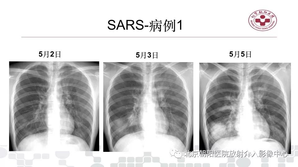 常见病毒性肺炎的ct影像表现