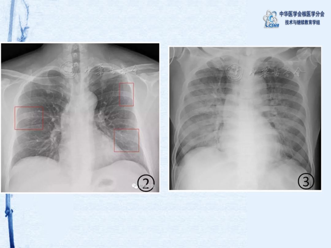 讲座73期姚稚明教授新冠肺炎x光检查集锦