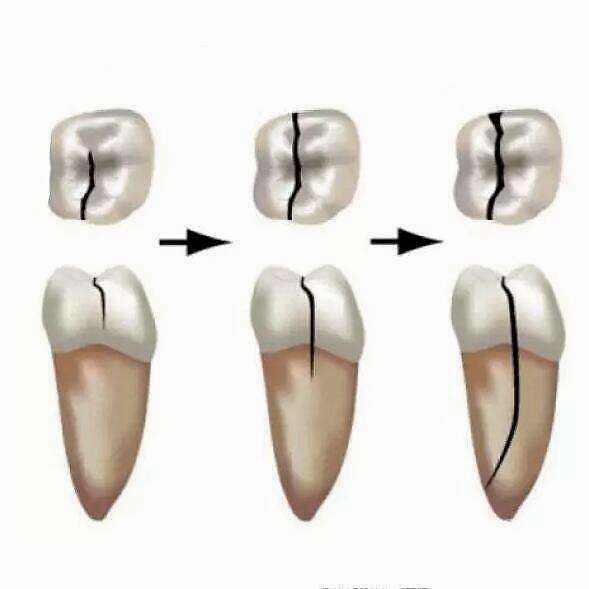 根管后牙齿裂了怎么办