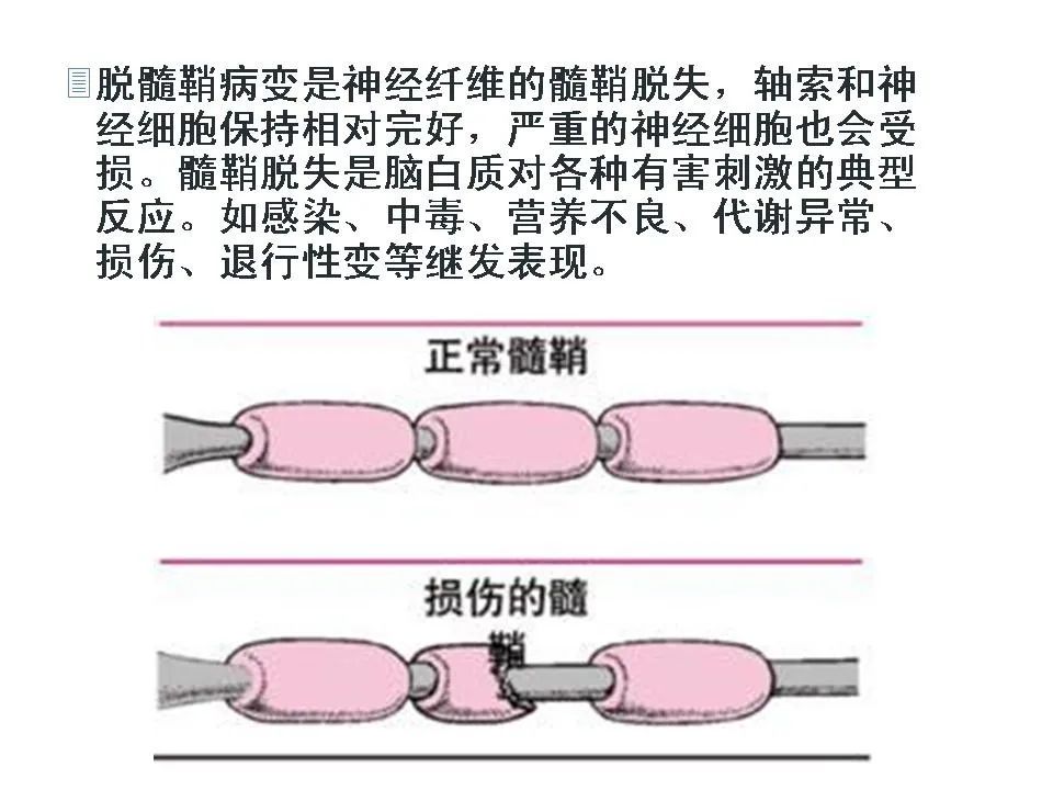 脑脱髓鞘疾病的影像诊断