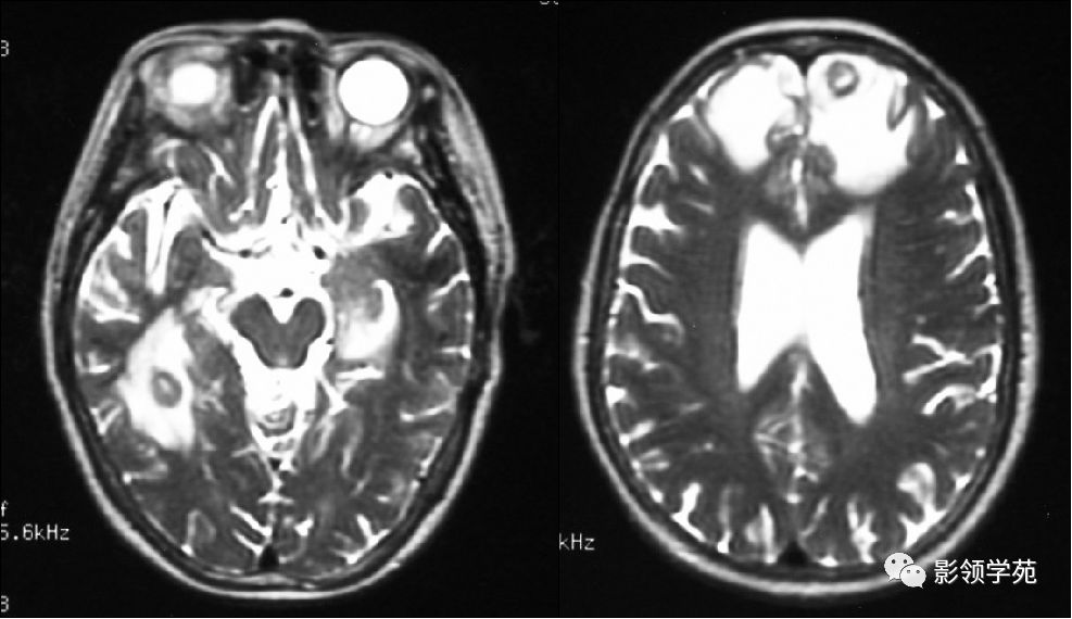 脑脓肿与脑结核的影像表现
