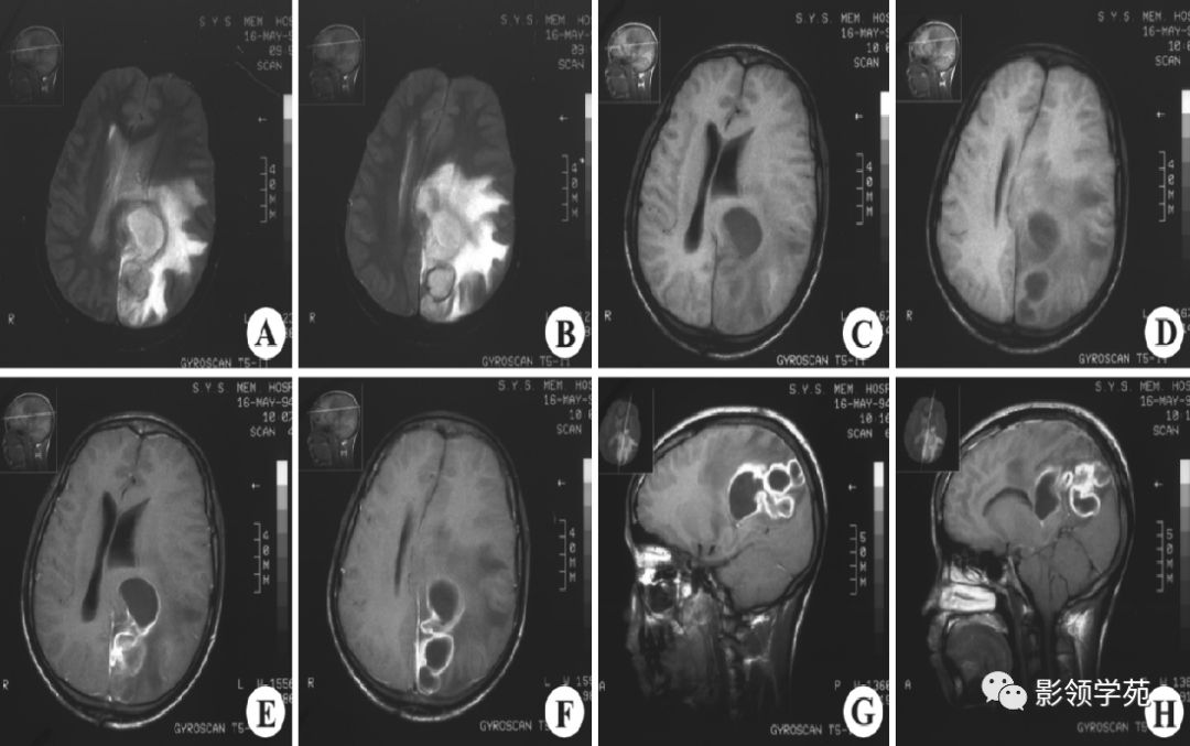 脑脓肿与脑结核的影像表现