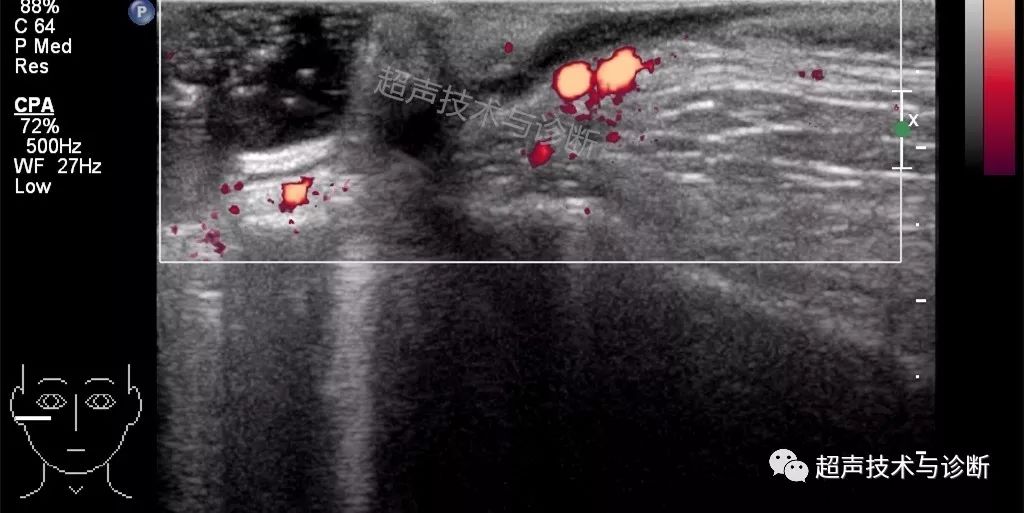 【浅表超声】鳃裂畸形——鳃裂囊肿,鳃裂瘘的超声诊断
