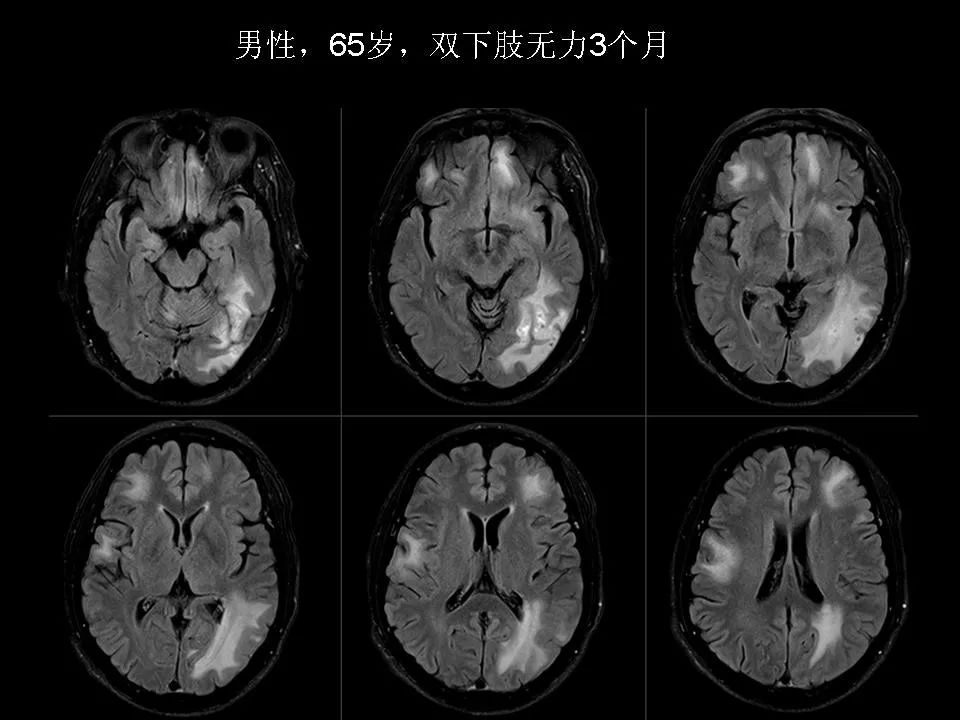 脑脱髓鞘疾病的影像诊断