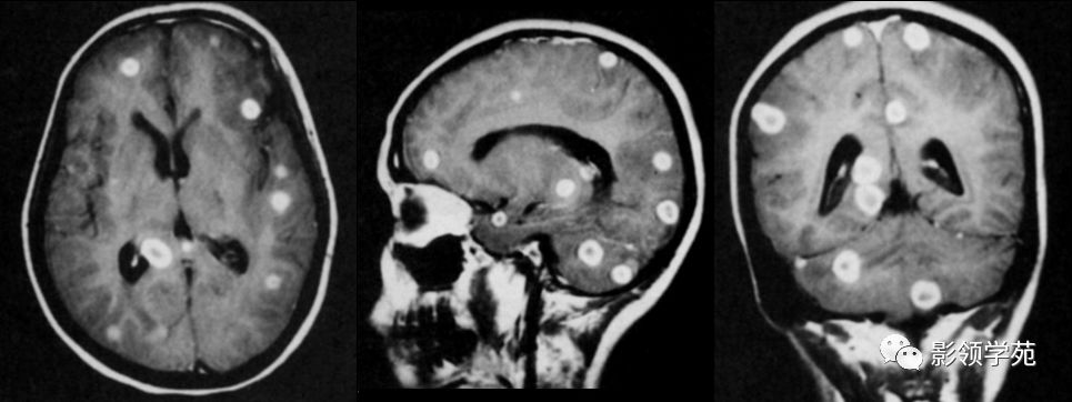 脑脓肿与脑结核的影像表现