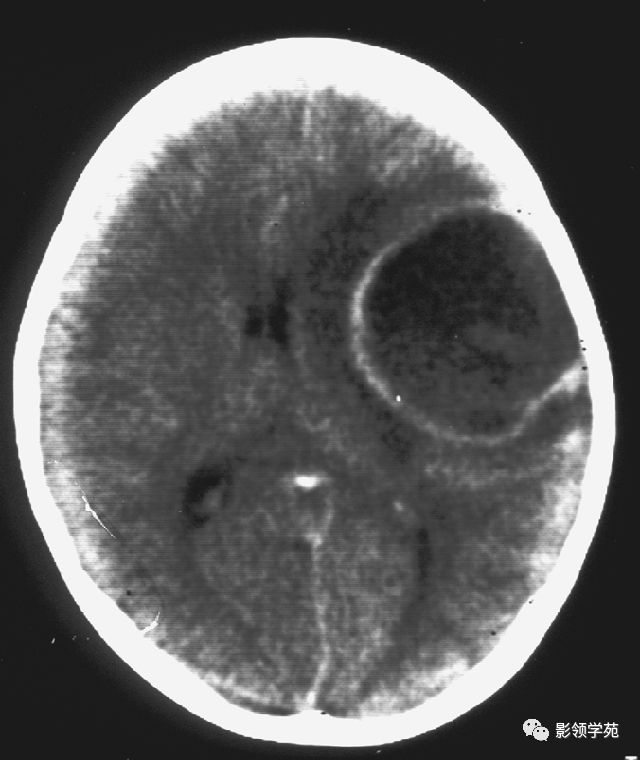 脑脓肿与脑结核的影像表现