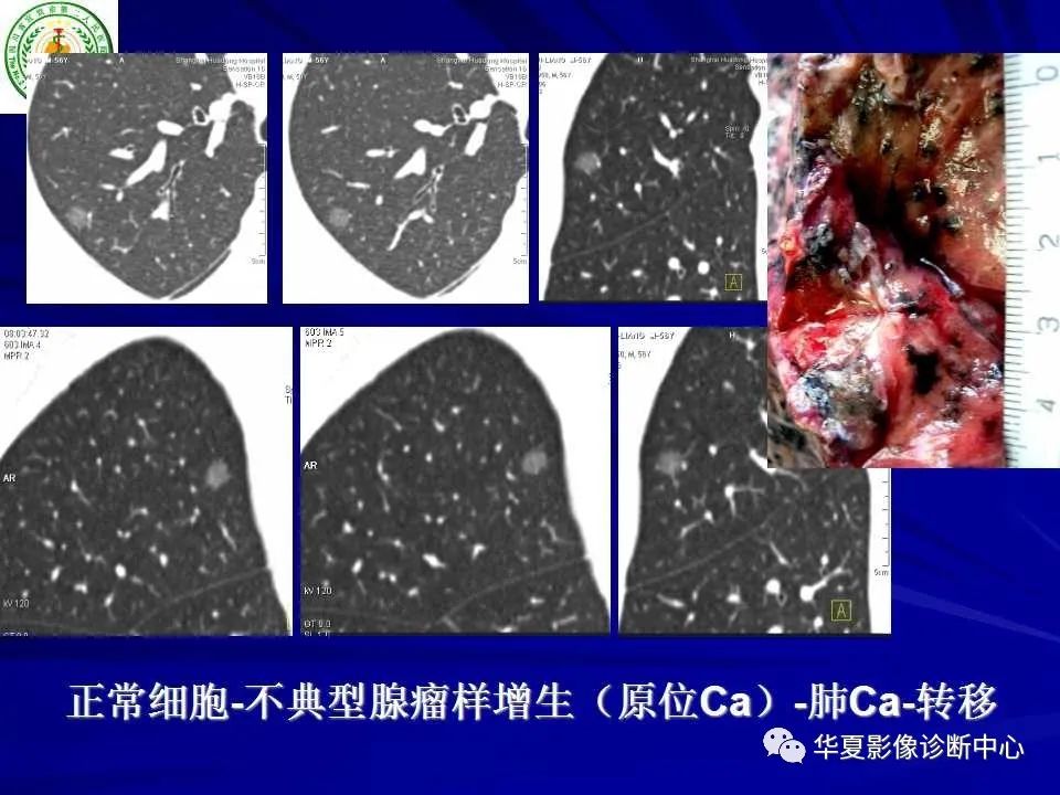 肺磨玻璃结节的ct诊断