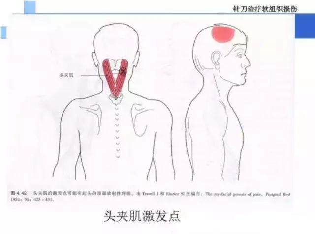 针刀治疗头夹肌劳损图解!_技巧