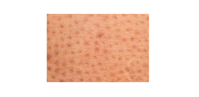 肌肤问题∣什么是『鸡皮肤』?警惕肌肤上这些类似粉刺