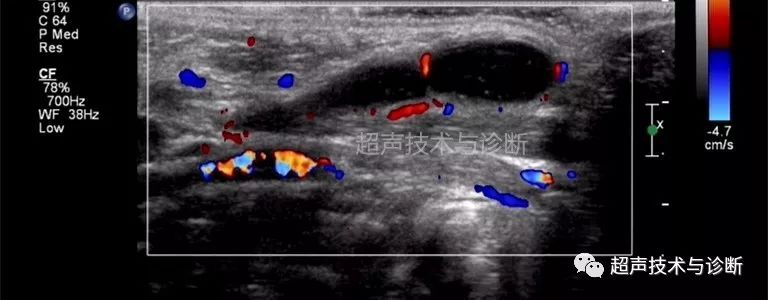 【浅表超声】鳃裂畸形——鳃裂囊肿,鳃裂瘘的超声诊断