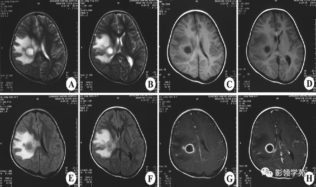 脑脓肿与脑结核的影像表现