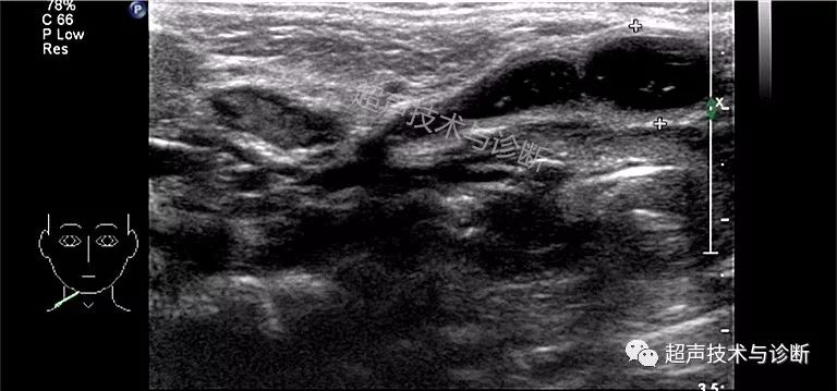 【浅表超声】鳃裂畸形——鳃裂囊肿,鳃裂瘘的超声诊断