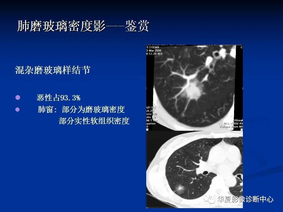 了解一下非新冠肺炎的磨玻璃影