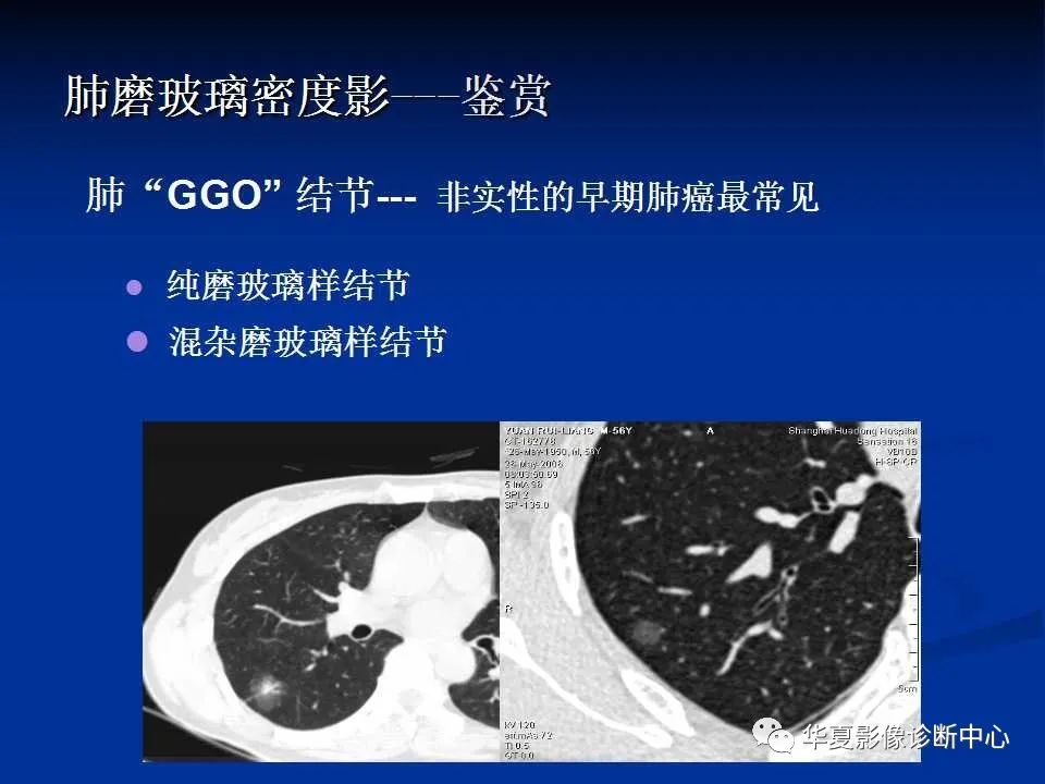 了解一下非新冠肺炎的磨玻璃影