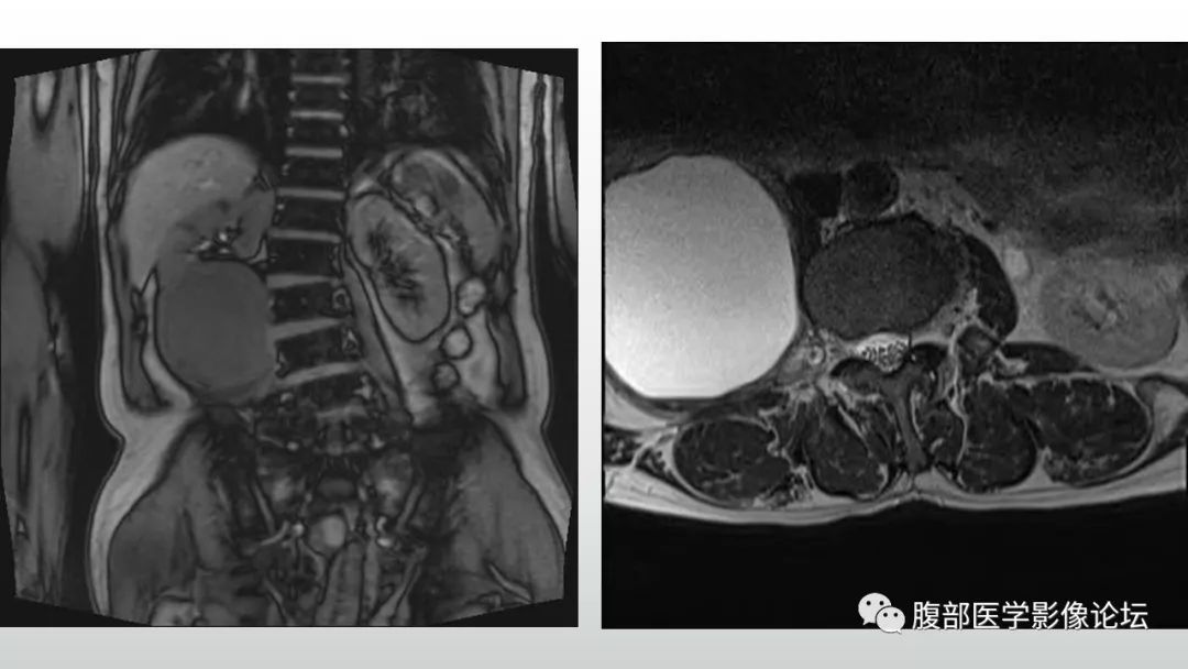 李广明:右侧腰大肌囊性病灶,与肾脏分界清晰,呈圆形,可见两层囊壁