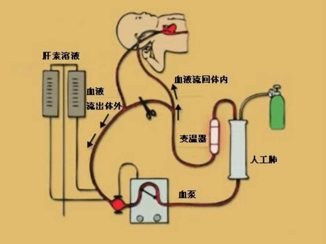 原创一套人工肺成本上百万元还只能进口期待国产尖端医疗设备崛起