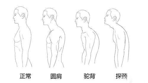 斜肩,内缩肩,圆肩及驼背?这些影响气质的身材你有吗