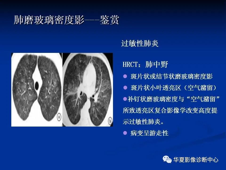 了解一下非新冠肺炎的磨玻璃影