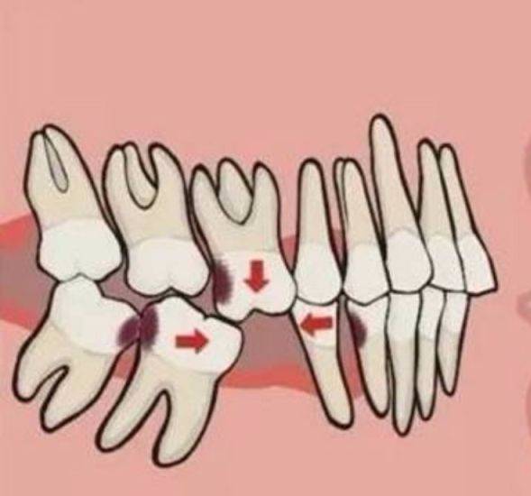 错颌畸形,包括我们常见的牙齿拥挤,地包天,龅牙等等,不仅不美观