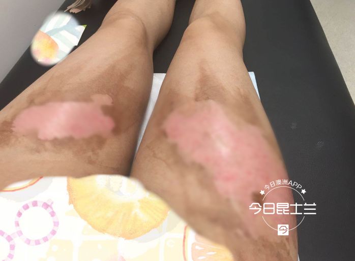 大腿触目惊心！布市华人女孩严重烫伤，只因水