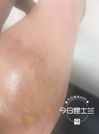 大腿触目惊心！布市华人女孩严重烫伤，只因水