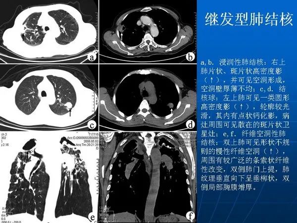 各型肺结核的典型影像表现