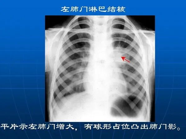 各型肺结核的典型影像表现