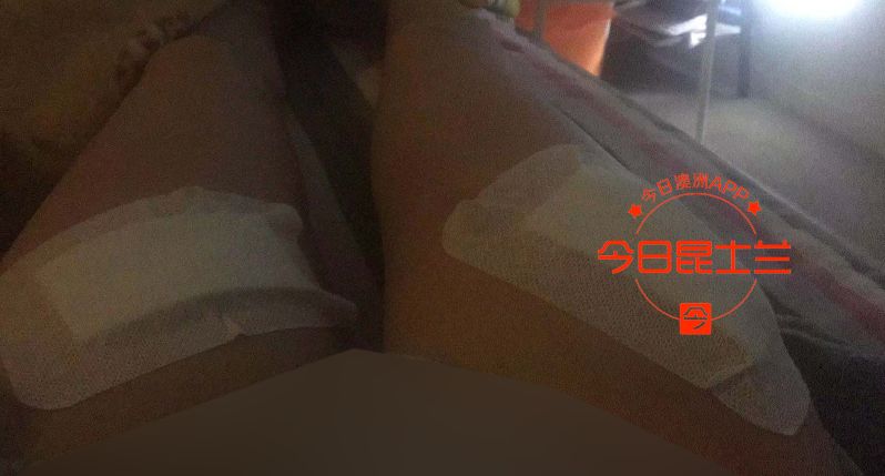 大腿触目惊心！布市华人女孩严重烫伤，只因水
