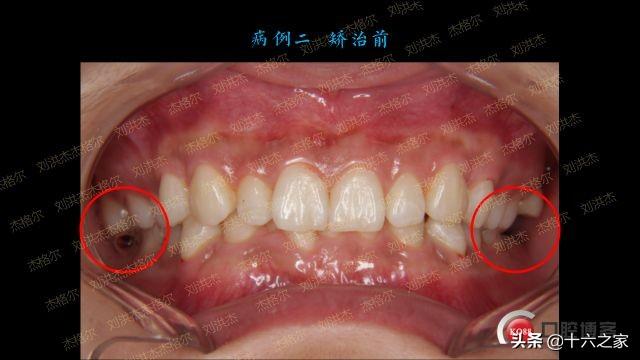 三例上颌磨牙颊侧倾斜引起正锁颌的矫治策略