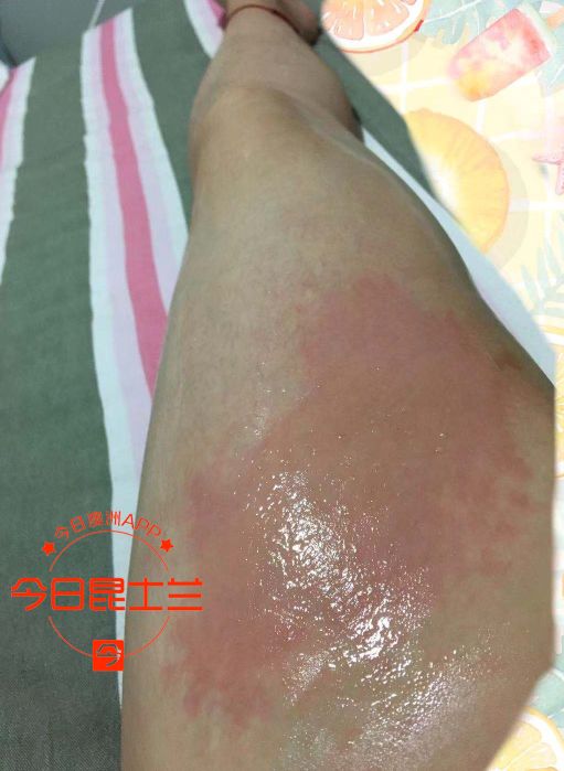 大腿触目惊心！布市华人女孩严重烫伤，只因水