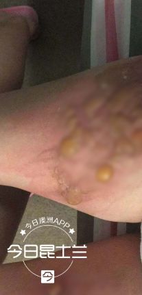 大腿触目惊心！布市华人女孩严重烫伤，只因水