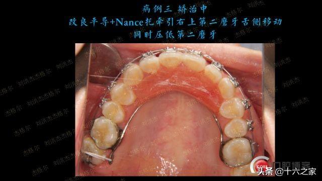 三例上颌磨牙颊侧倾斜引起正锁颌的矫治策略