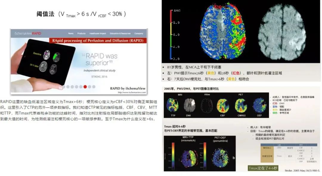 宣5悟道丨缺血半暗带的临床意义和评估方法