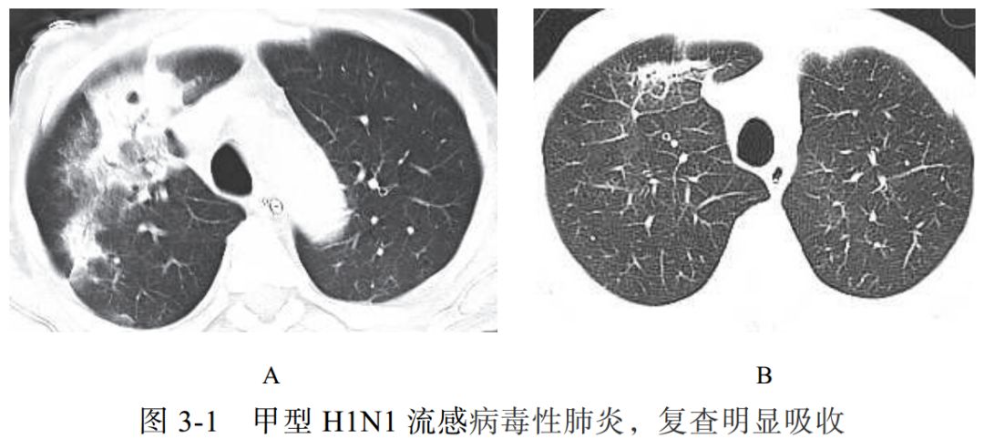 本病起病急,高热,并发症多 影像学表现:  (1)多呈大叶性分布(图 3-2a)