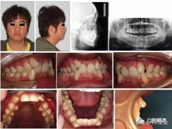 成人上颌尖牙阻生的内倾型深覆牙合拔牙矫治1例
