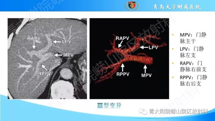 门静脉解剖,变异及常见病变影像表现