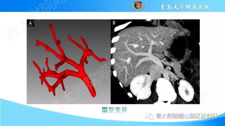 门静脉解剖变异及常见病变影像表现