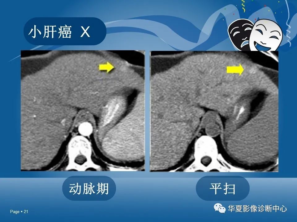 原发性肝细胞癌的ct和mri诊断