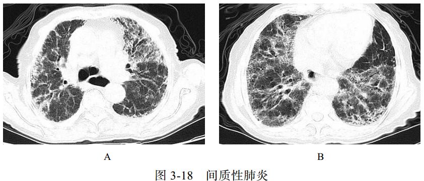 影像学表现:两肺支气管血管束增多,网格状及小点状影,周围夹杂多发