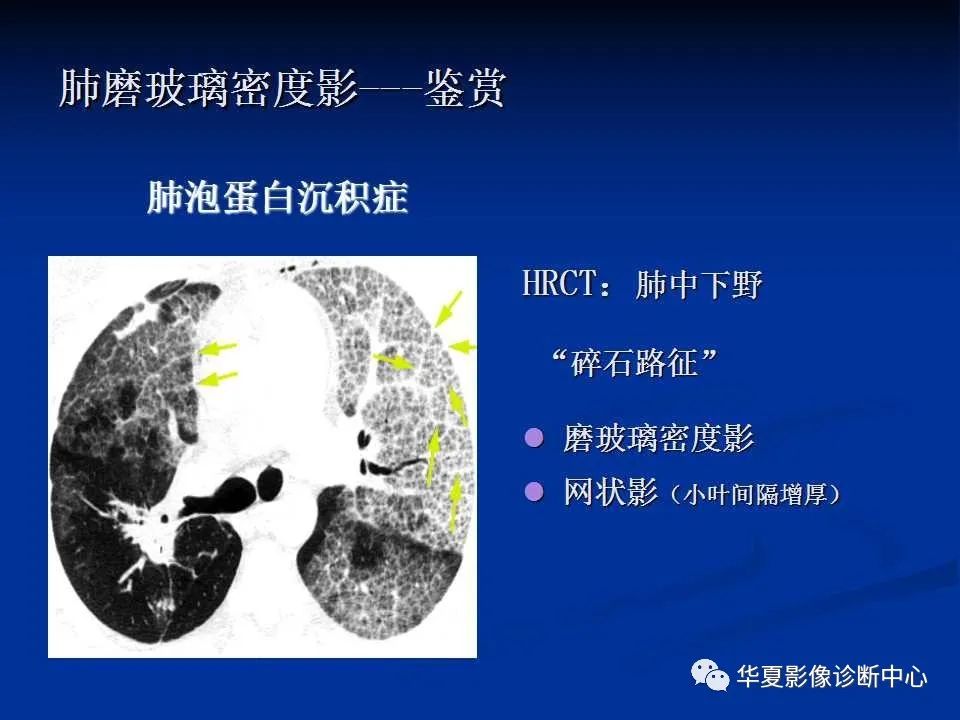 认识非新冠肺炎的磨玻璃影
