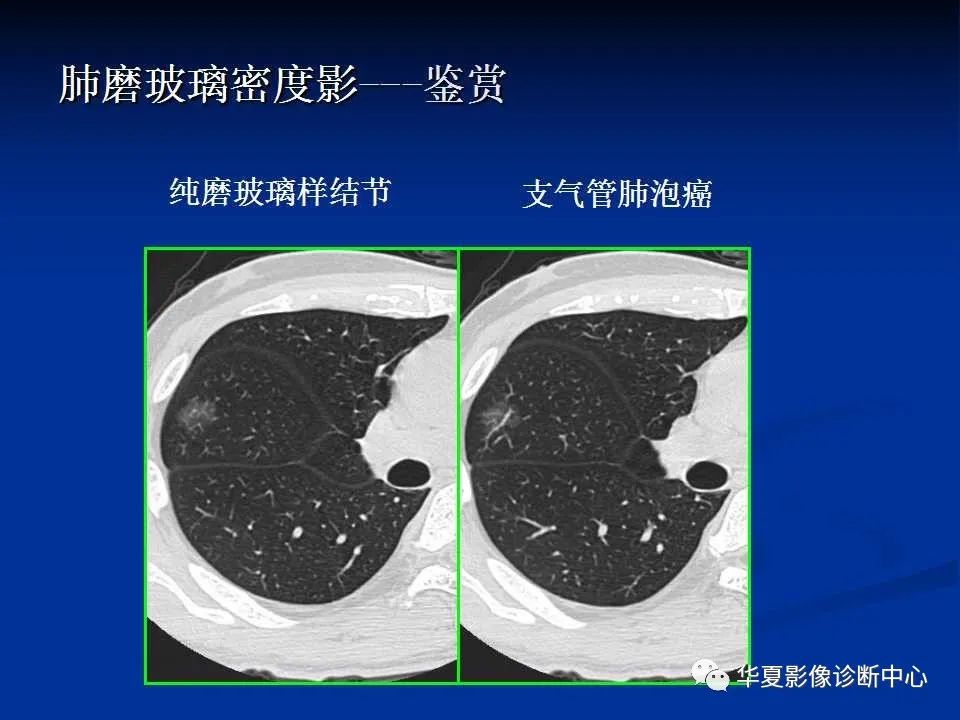 认识非新冠肺炎的磨玻璃影