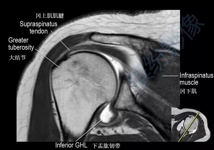 肩关节斜冠状面mr断层解剖