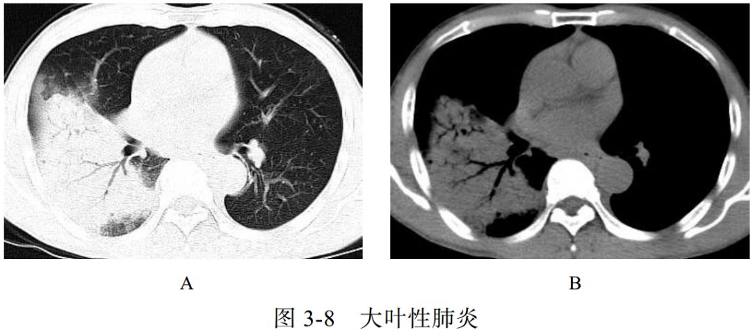 电子书精选 | 新冠肺炎ct早期征象与鉴别诊断