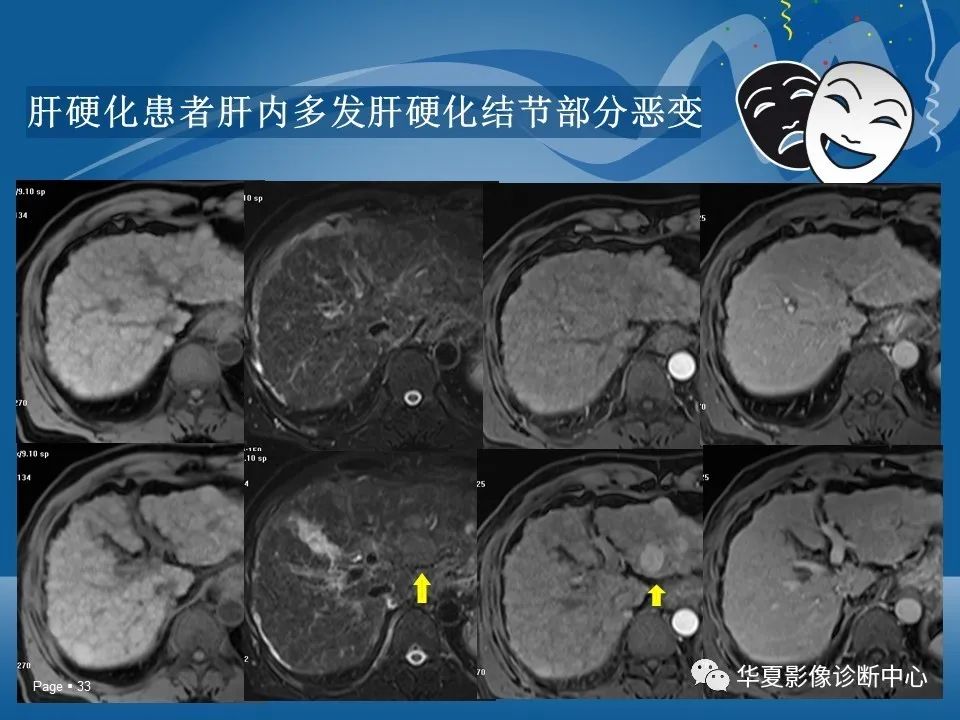 原发性肝细胞癌的ct和mri诊断