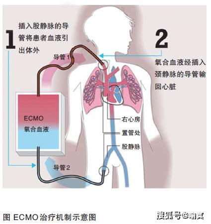 无锡一新冠患者通过ecmo换肺成功,但是ecmo治疗费用昂贵,不适合大众