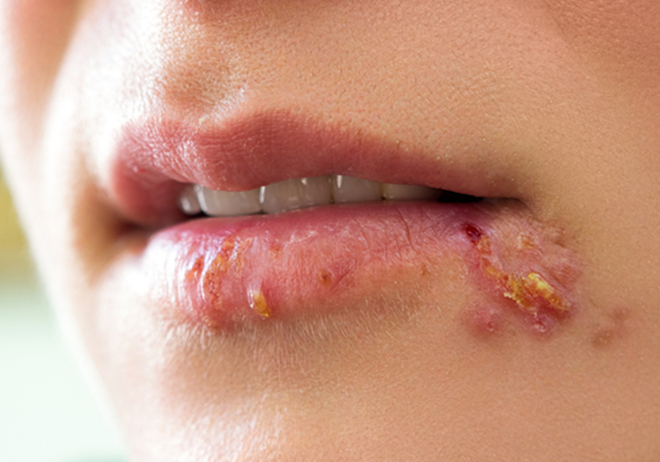 疱疹怎么快速消 d1daa3b91f5848639002dccd6460946b.jpeg