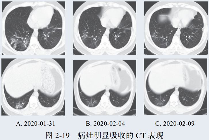 表现为病灶逐步吸收,可遗留少许条索状高密度影,提示纤维化