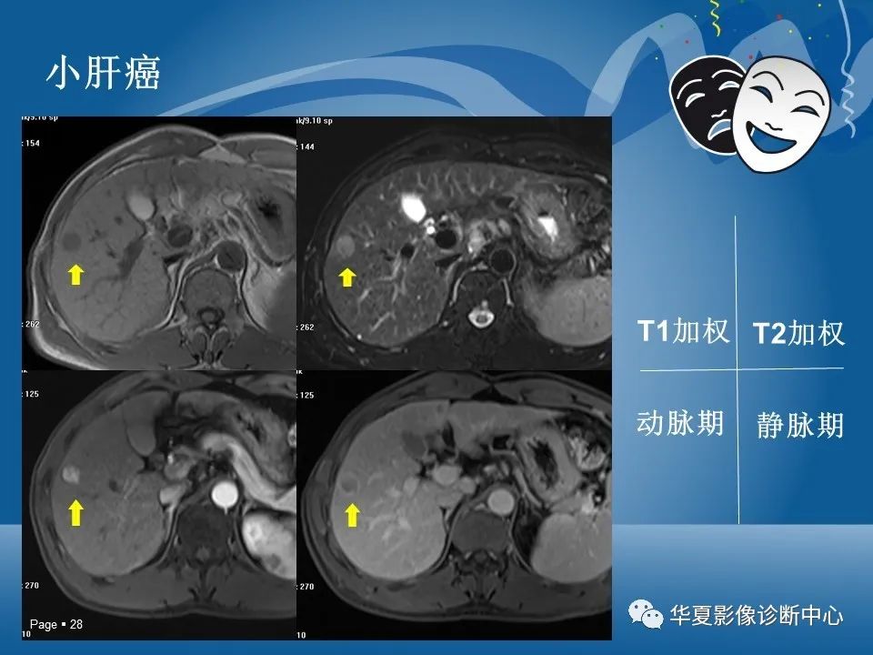 原发性肝细胞癌的ct和mri诊断